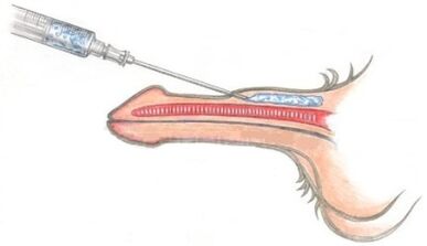 A introdución de materiais poliméricos no pene para engrosalo