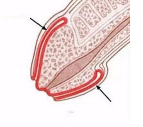 Inflamación do pene