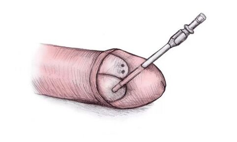 A cabeza do pene pódese agrandar inxectándolle xel hialurónico