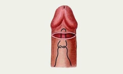 glande pene
