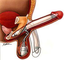 Implantes de ampliación do pene masculino